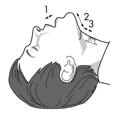 Trauma LEMON airway assessment Assessment Look Description Examine for gross abnormalities or lesions: facial trauma, large tongue, large incisors, beard/moustache 4 p Evaluate 3-3-2 rule