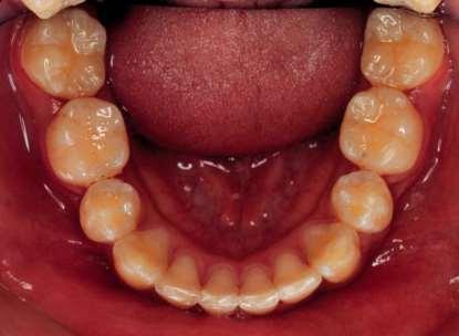 premolaris
