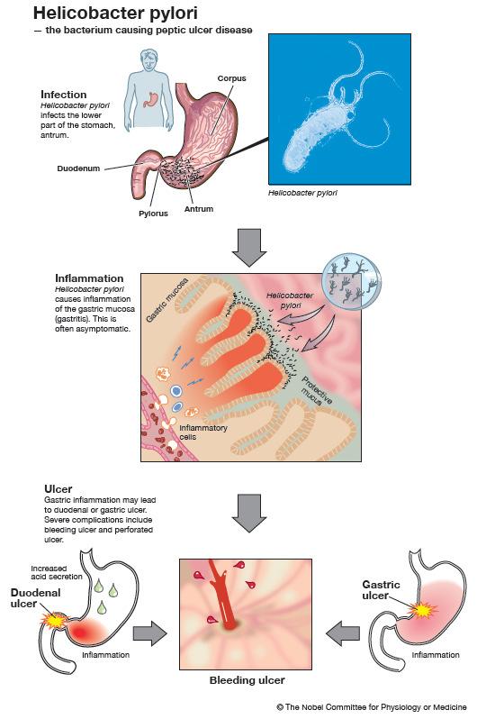 Mikor a szabályozás félresiklik: a Zollinger-Ellison szindroma szabályozatlan gastrin termelés (tumor) HCl duodenum ph pancreas enzimek nem működnek nagy mennyiségű pancreasnedv intraluminális