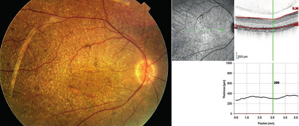 Characteristics of CRB1 (Crumbs homologue 1) gene associated retinopathies bevezetés A Crumbs homologue 1 (CRB1) elnevezés a Drosophilában azonosított Crumbs-gén és fehérje humán megfelelőjére, a gén