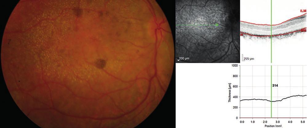 Characteristics of CRB1 (Crumbs homologue 1) gene associated retinopathies disztrófia diagnózisa csak klinikánkon merült fel.
