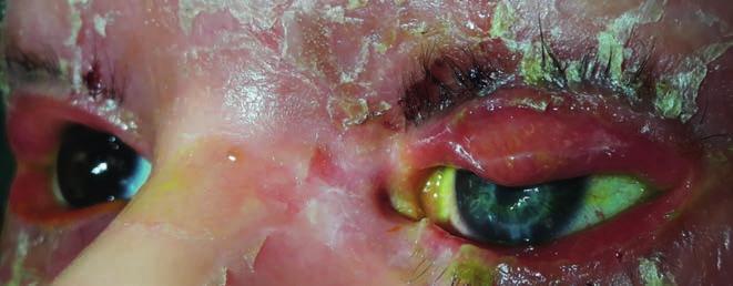 Ectropion in harlequin ichthyosis 1. D ábra: négy hónappal az ismételt mini à chaud keratoplasztika, valamint bal oldali felső és alsó szemhéj teljes vastagságú bőrátültetése utáni állapot.