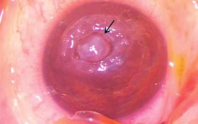 Ectropion in harlequin ichthyosis 2. B ábra: Ismételt mini à chaud keratoplasztika előtt (hathéttel az első keratoplasztika után), varratszedés és a váladékok eltávolítása után.