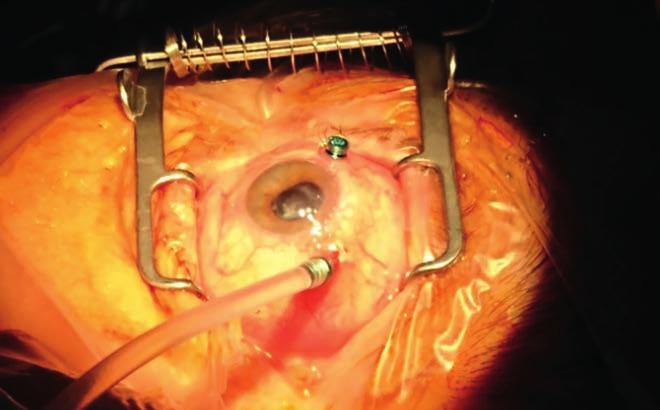 Endocyclophotocoagulatio bevezetés A corpus ciliare a szem legnehezebben vizsgálható része, közvetlen vizualizáció szinte kivitelezhetetlen.