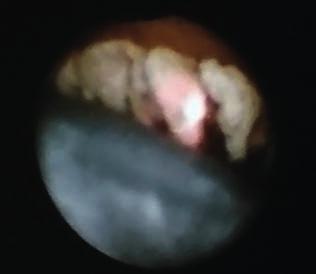 Endocyclophotocoagulatio 3.