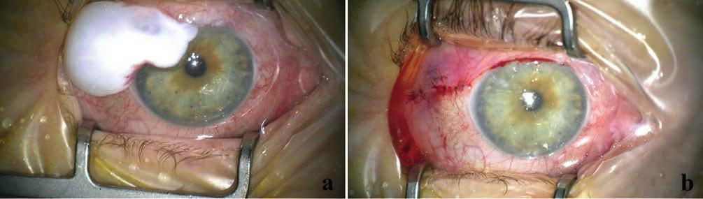 Cystic filtration bleb as a complication of extracapsular cataract extraction 1.
