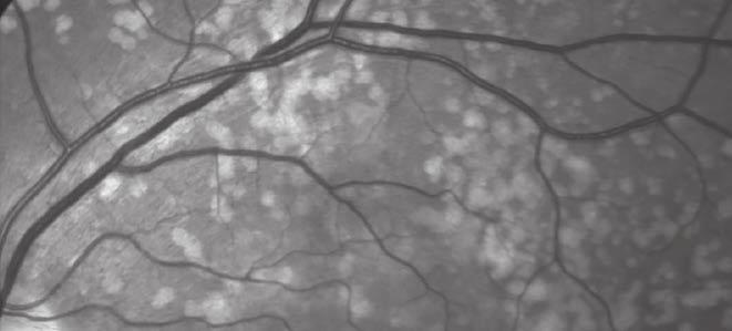 Az oct-felvétel bal oldalán a drusen mellett jól kivehető a retina kül - ső rétegének mind a négy jellegzetes csíkja, ez subretinalis druse - noid depozit hiányát igazolja.