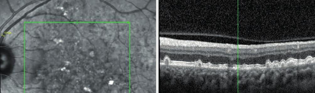 kapcsolatban rendkívül fontos adatokat szolgáltatott az AREDS (Age-Related Eye Disease Study) (1) vizsgálat kontrollcsoportja.
