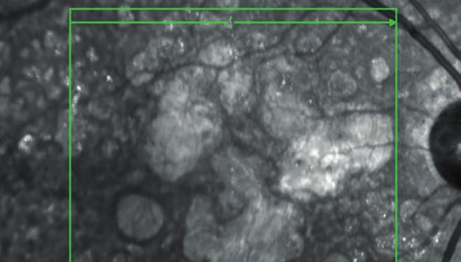 Ezek a drusenek igen aprók, és jellegzetességük, hogy sokkal több látszik belőlük fluorescein angio grá - fián, mint a szemfenéki képben vagy színes fotókon.