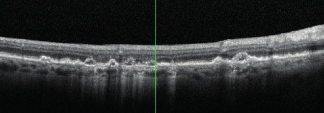 lévő kolla - génréteg között helyezkedik el (Ba- sal Linear Depozit, Blind), mint a diffúz drusen vagy a nagy dru senek (29).