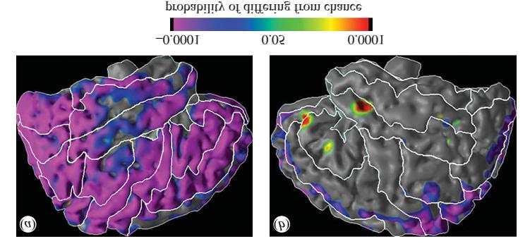 Neuroimaging marker MRI jobb bal Talati