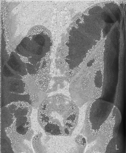 Cajal-sejtek Vastagbélmozgások szabályozása EIR gátló neuronjai Hirschsprung-betegség - megacolon