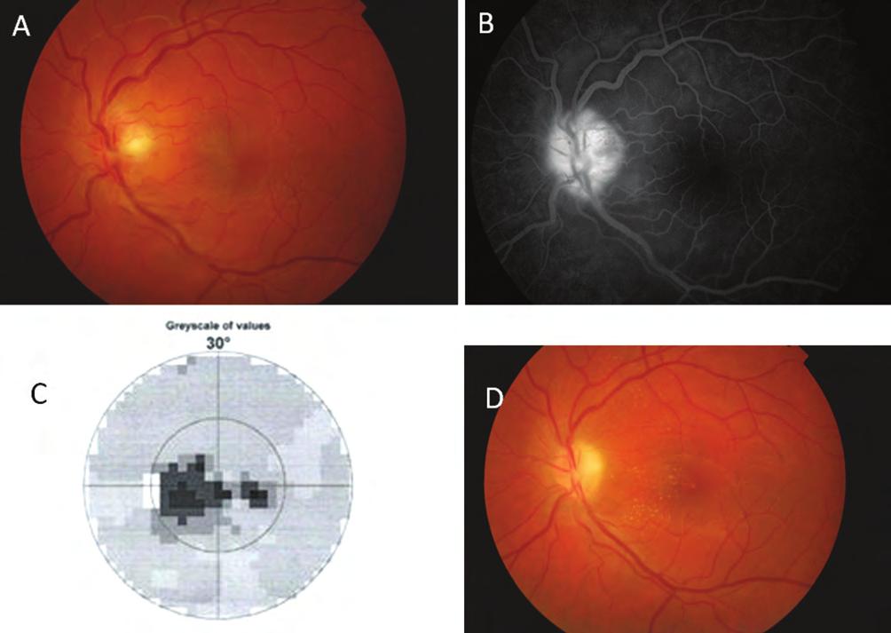 Optic disc edema and differential diagnosis questions alakulhatnak ki. Sub hya loi dealis vérzés is jelentkezhet, amely időnként az üvegtesti térbe is törhet.