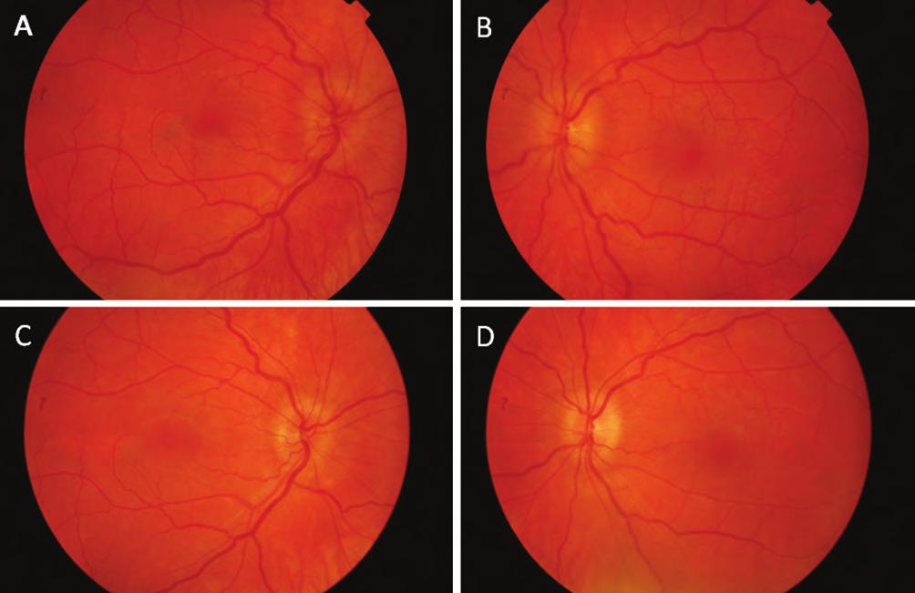optic disc edema and differential diagnosis questions rápia szünetében a beteg a bal szemével foltokat kezdett látni. Vizs - gálatakor a látóélesség mindkét oldalon myopiás korrekcióval 1.