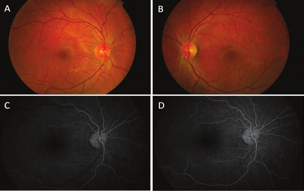 Optic disc edema and differential diagnosis questions 4.