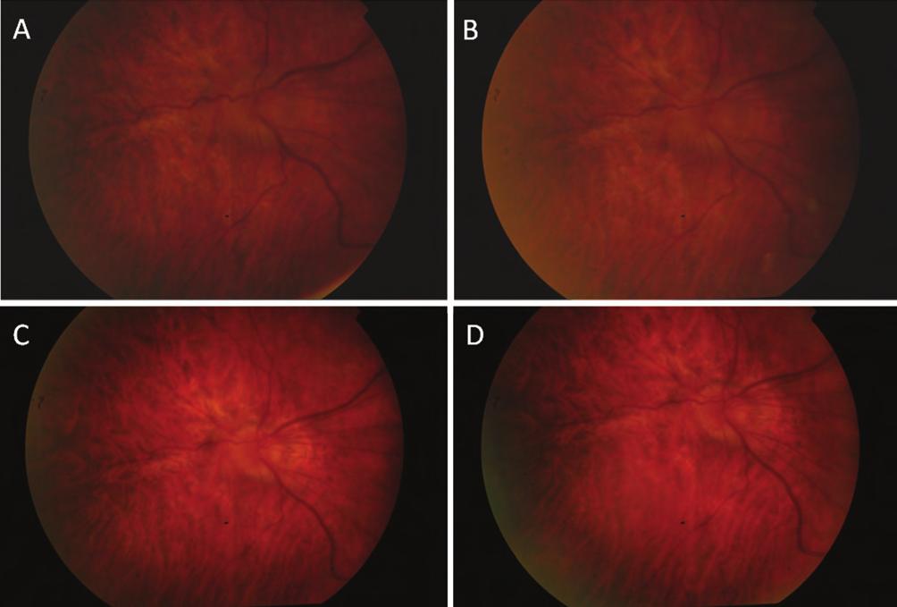 Papillaödéma és differenciáldiagnosztikai kérdések Lyme-kór), gyulladásos rendszerbetegség (pl. sarcoidosis), autoimmun betegség (pl. SLE).