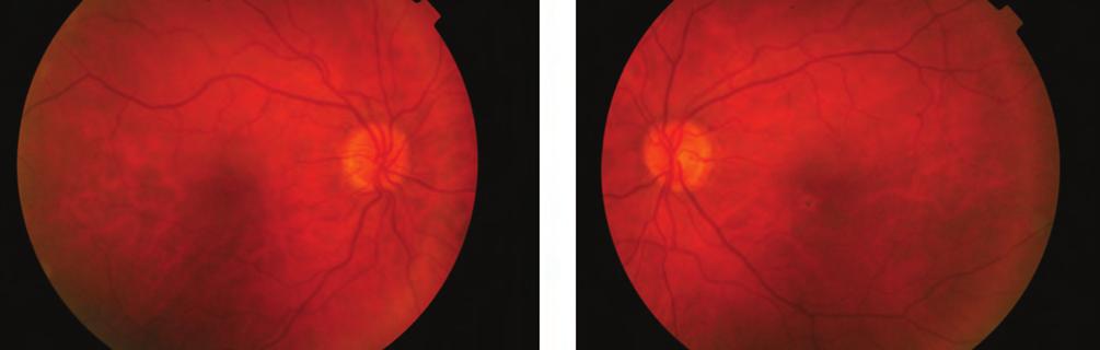 ophthalmic side effect of the systemic MEK inhibitor therapy Bevezetés A bőr eredetű melanoma malig - numban szenvedő betegek száma évtizedenként megduplázódik.