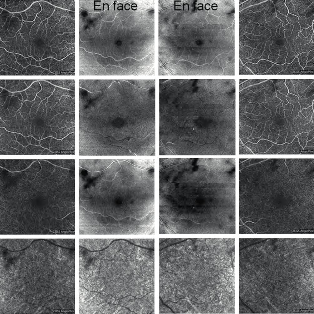 ophthalmic side effect of the systemic MEK inhibitor therapy 3. ábra (1. eset): optovue Angiovue oct (optovue Inc., fremont, ca, usa) angio gráfiás készülékkel készített felvételek.