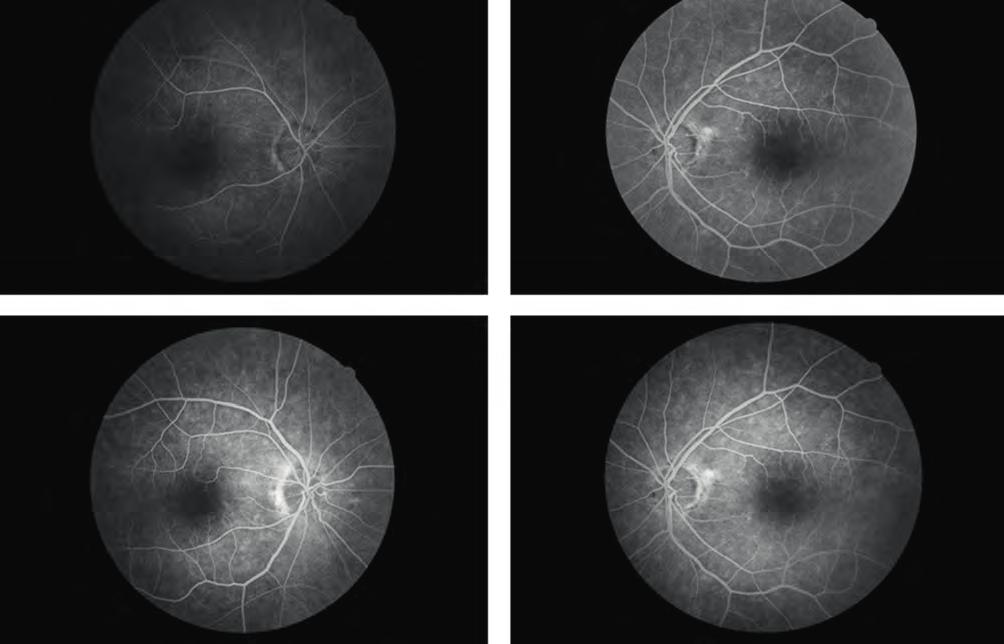eset): fluoreszcein angiográfiás felvétel a beteg első megjelenésekor a MEK-inhibitor terápia miatt kialakult neuroszenzoros retinaleválás idején.