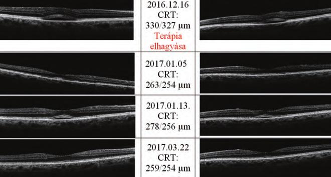ophthalmic side effect of the systemic MEK inhibitor therapy 6. ábra (2.
