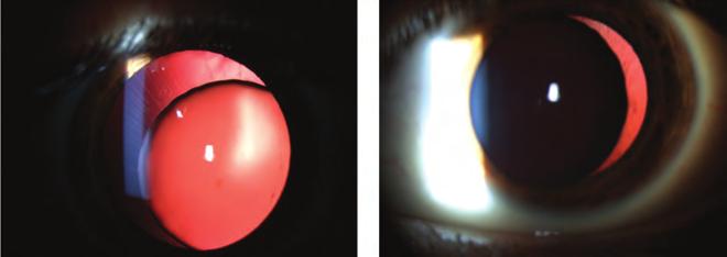 Bilateral progressive myopia and dislocation of lens in childhood Bevezetés A klasszikus homocisztinúria egy autoszomális recesszív módon öröklődő megbetegedés, amelyet az esetek nagy hányadában