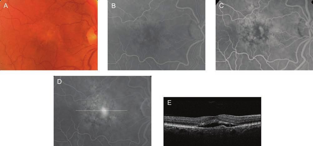 What we know today about age-related macular degeneration Bruch-membrán sérülésein áttörve (1.