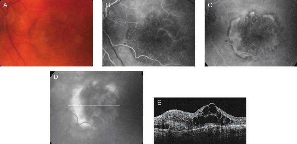 Amit ma tudunk az időskori macula degenerációról eszcein angiogrammon a klasszikus CNV-t (3. ábra) jól körülhatárolt hiperfluoreszcencia jellemzi már a korai fázisban (3.