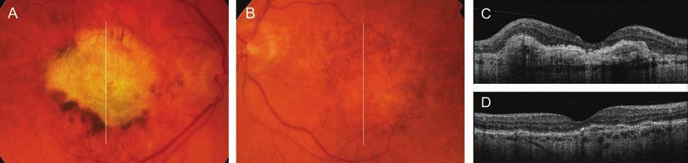 What we know today about age-related macular degeneration 7.