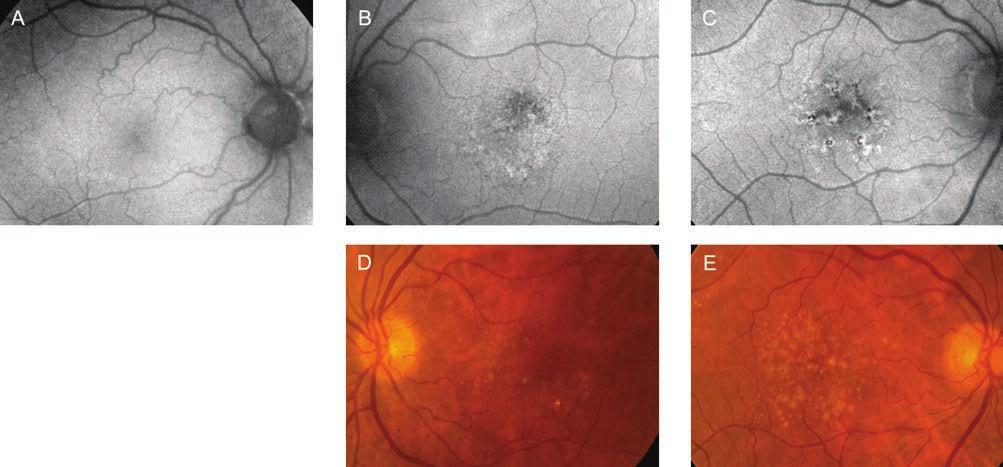 Amit ma tudunk az időskori macula degenerációról 9. ábra: Fundus autofluoreszcencia (FAF). A felvételek Topcon 3D OCT-2000 FA plus készülékkel készültek.