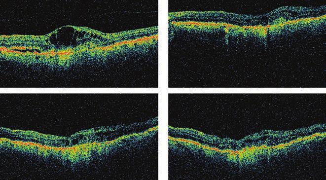 Cataract surgery in intravitreal ranibizumab injection-treated patients 4. ábra: Egyik betegünk centrális retina vastagságának változása OCT-felvételeken ábrázolva.