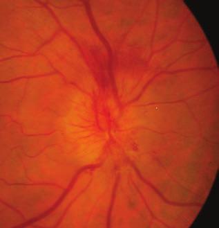 Non-arteritic anterior ischemic optic neuropathy TERMINOLÓGIA ÉS KLASSZIFIKÁCIÓ A nem-arteritises elülső ischaemiás opticus neuropathia azon súlyos látásromlást okozó betegségek közé tartozik,