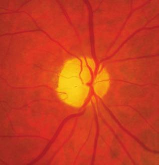 Nem-arteritises elülső ischaemiás opticus neuropathia 2.