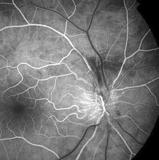 Non-arteritic anterior ischemic optic neuropathy kialakuló kompresszió következménye (31, 32).
