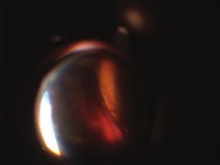 CT-vel diagnosztizált posztoperatív expulzív vérzés esete 4.