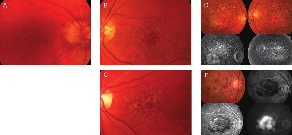 Amit ma tudunk az időskori macula degenerációról lis sejteket összekapcsoló zonula occludensek képezik a külső vér-retina-gátat.