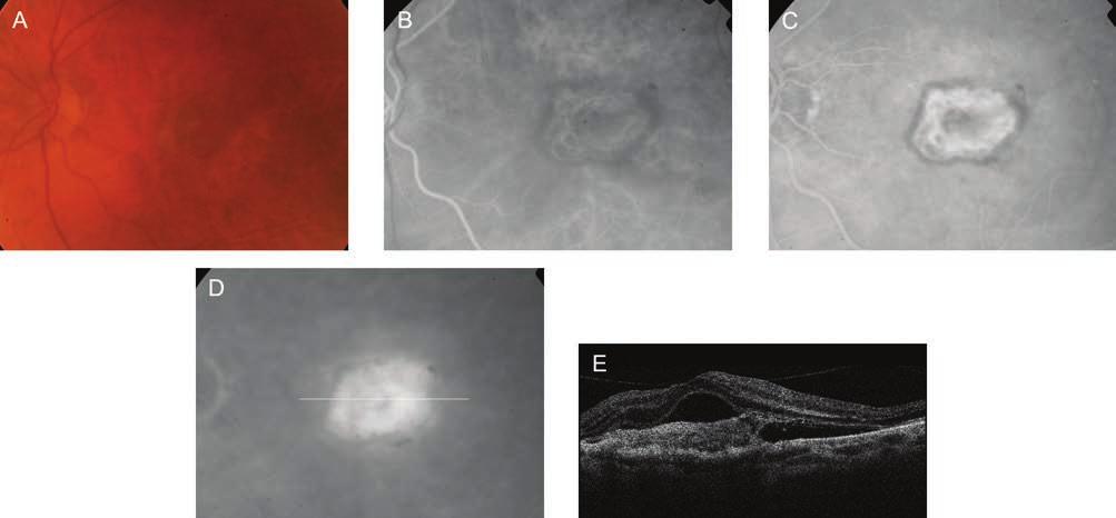 What we know today about age-related macular degeneration hoz, krónikus gyulladáshoz vezet (52).