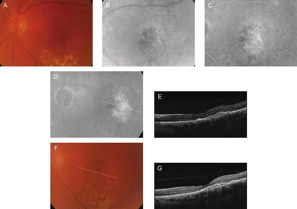 Amit ma tudunk az időskori macula degenerációról igényli: a vaszkuláris endotheliális növekedési faktorok (VEGF) fokozott termelése mellett az angio - sztatikus molekulák, mint pl.