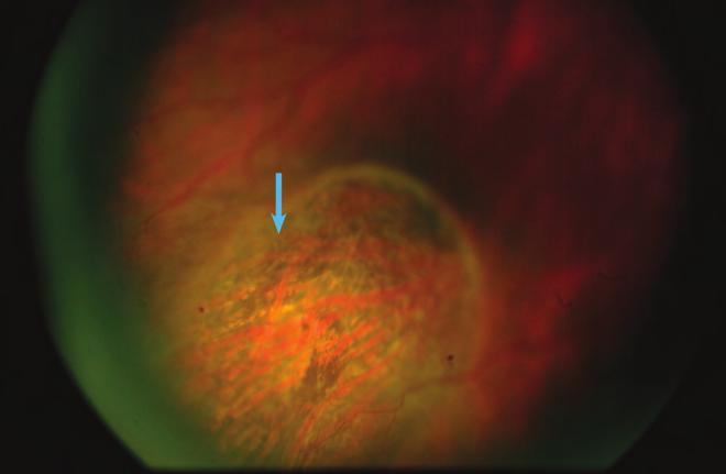 Evaluation and management of rhegmatogenous retinal detachment 11. ábra: Radier sclerabedomborításon mérsékelten pigmentált régi koagulációs hegek figyelhetők meg 12.
