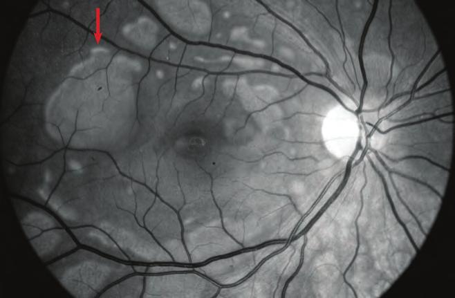 A folyadékzárványokat a subretinalis térbe került perlfuorokarbon folyadék okozza, amely a műtét során folyadék/perfluorodecalin csere kapcsán került az elemelkedett retina szakadásán keresztül oda
