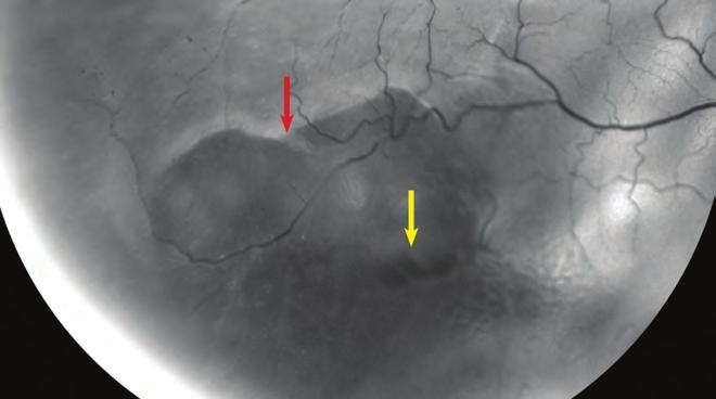 Evaluation and management of rhegmatogenous retinal detachment 13. ábra: A vörösmentes fényben készített felvételen retinoschisishez kapcsolódó retinaleválás látható.
