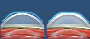 The role of orthokeratology in myopia control Arövidlátás az egyik leggyakrabban előforduló szemészeti elváltozás, amelynek gyakorisága az elmúlt évtizedek során fokozatosan emelkedik, főként a