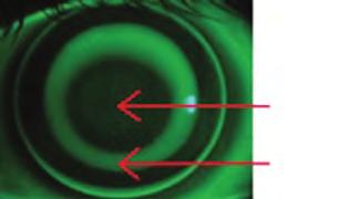 Az orthokeratológia helye a myopia progressziójának lassításában 3. ábra: Orthokera to ló - giás kontaktlencse a sze men, fluoreszceinnel megfestve.