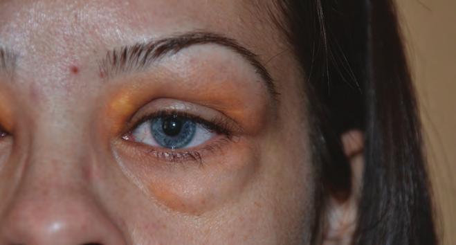 Adult onset asthma and periocular xanthogranuloma Case report Az orbita, illetve a szemhéj szöveteinek felnőttkorban kialakuló xantogranulómás elváltozásai igen ritkán előforduló, ismeretlen