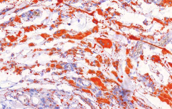 Adult onset asthma and periocular xanthogranuloma Case report 3. C ábra: Zsírnemű anyag a xantómasejtekben és az óriás sejtekben (Oil-red-O festés) 3.