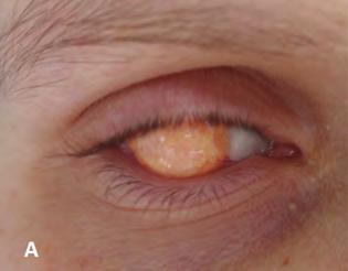 Rare Ocular symptoms in malignant histiocytosis, Erdheim Chester disease 2. ábra: 24 éves nőnél (2012). A: jobb oldalon a szaruhártyát teljes terjedelmében sárgás, gra - nulomatosus szövet fedi be.