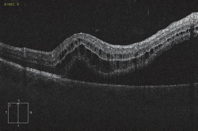 Evaluation and management of rhegmatogenous retinal detachment Az ablatio retinae fogalma alatt a neuroepithelium és a pigmenthám egymástól történő szeparálódását értjük.