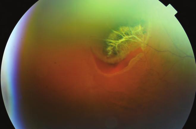 A rhegmatogen retinaleválás diagnosztikája és kezelése tom pa sérülés, gyulladásos folyamat vagy a retina nekrózisának következtében is, típusos formáik az ora serrata vonalában kialakuló re -