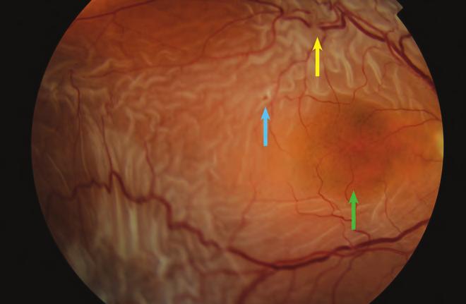 A rhegmatogen retinaleválás diagnosztikája és kezelése Az orthokeratológia  helye a myopia progressziójának lassításában A műlencse-helyzet becslési -  PDF Ingyenes letöltés