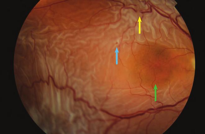 ábra: Epiretinalis membrán eltávolítása után kialakult retinaleválás hátterében a hátsó pólus temporalis széle közelében látható, valószínűleg iatrogen szakadás állhat (kék nyíl).