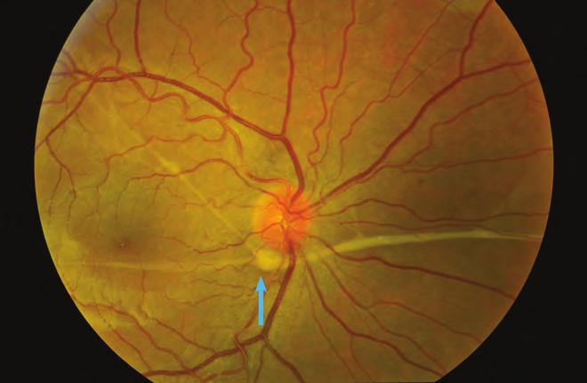 A rhegmatogen retinaleválás diagnosztikája és kezelése 7. ábra: A papilla alatt a retinát csak enyhén előemelő proliferatív subretinalis membrán észlelhető (PCR CP3).